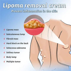 Herbal Lipoma Removal Cream – Natural Fat Peeling Solution